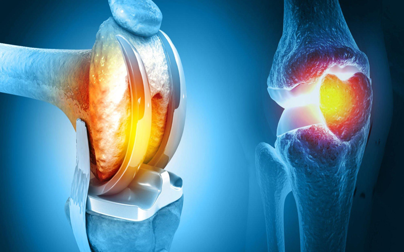 Best Knee Replacement Surgery In India 