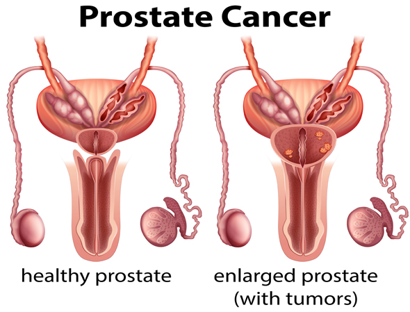Best Prostate Cancer Treatment Hospital In India