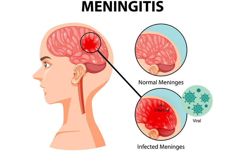 Cryptococcal Meningitis Treatment in India: A Comprehensive Guide by My Care India