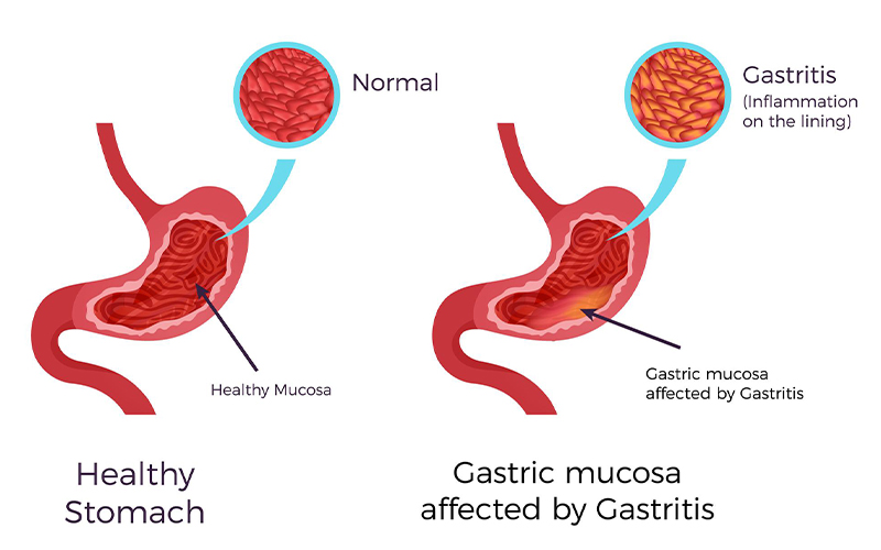 Gastric Balloon Surgery in India