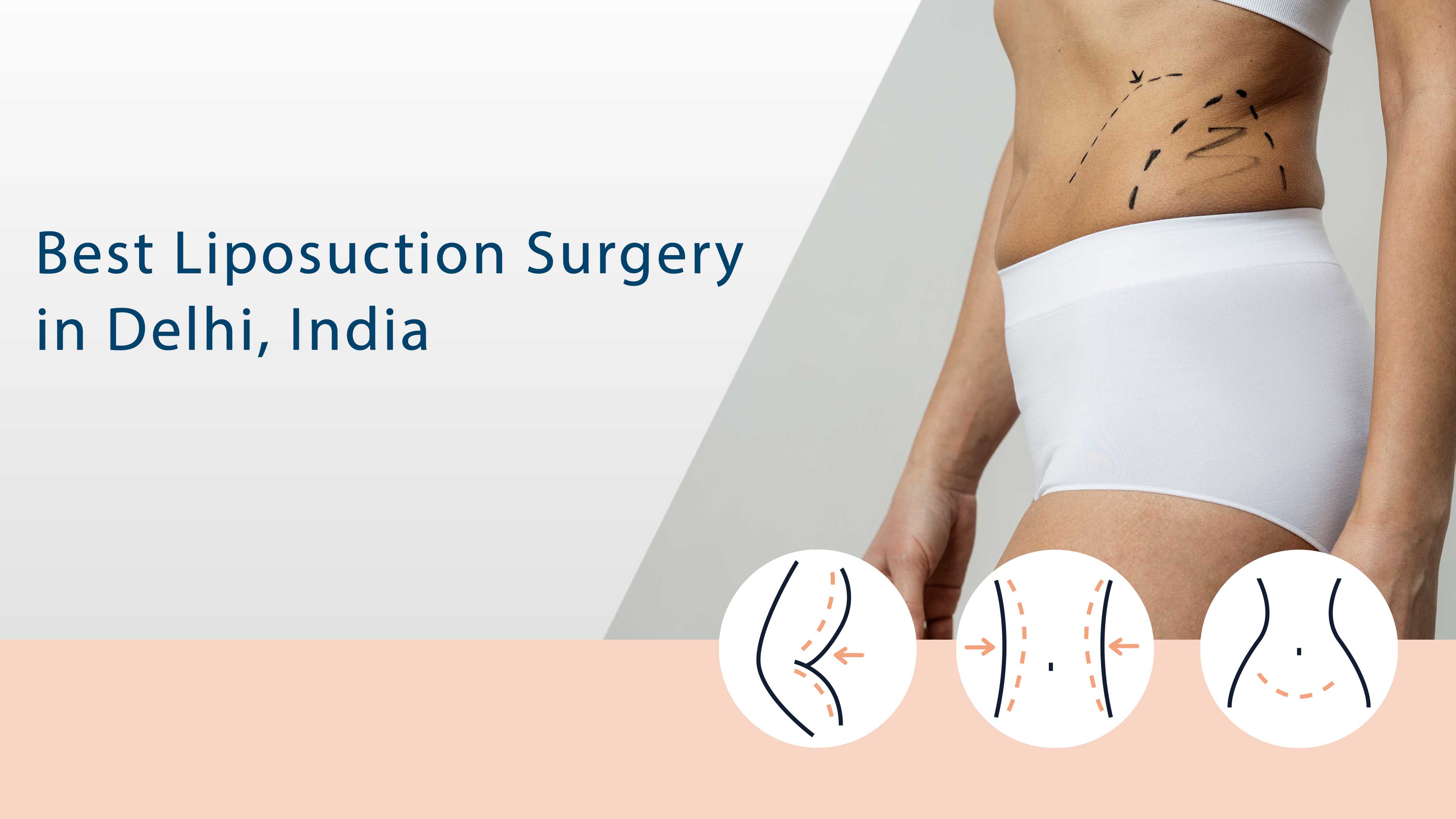Best Liposuction Surgery in Delhi, India