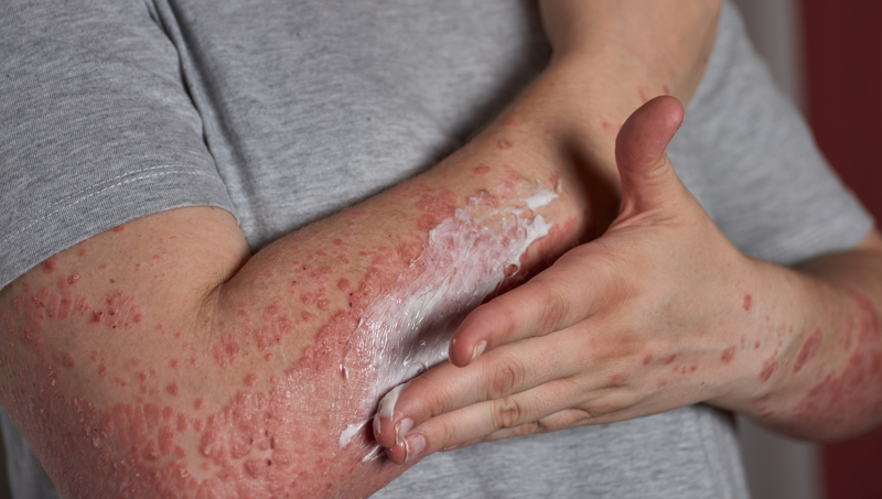 Best Doctor for Psoriasis in India