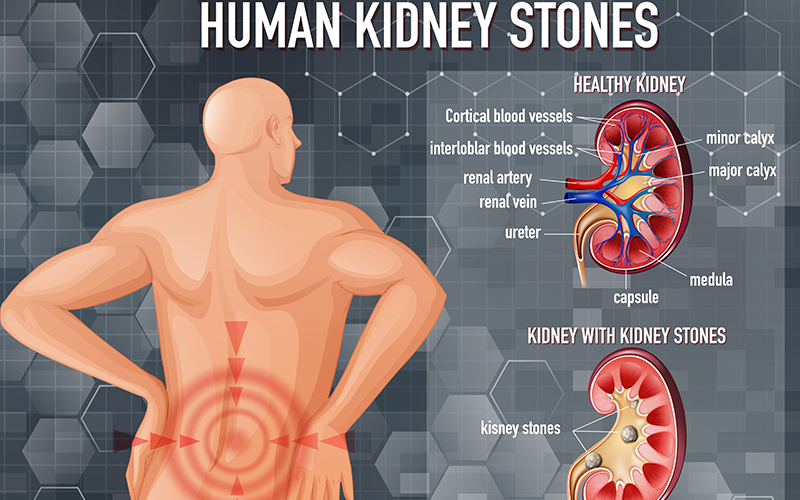 Kidney Stones: Causes, Symptoms, Diagnosis & Treatment