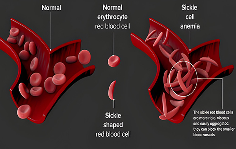 Sickle Cell Anemia Treatment in Delhi India