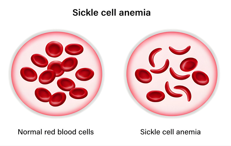 Sickle Cell Anemia Treatment in Delhi